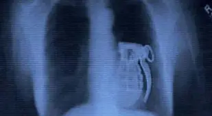 Live Grenade In Stomach