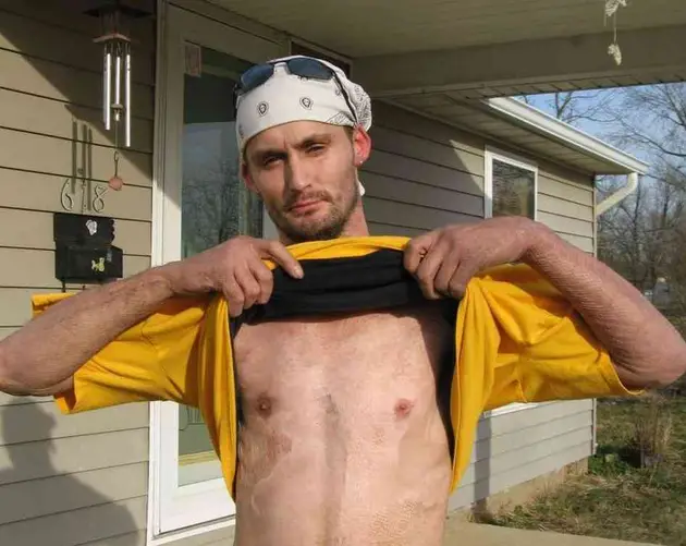 Meth Epidemic Burns