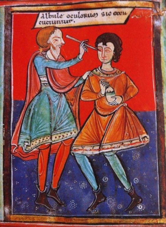 Outrageous Historical Treatments Cataract Removal 2