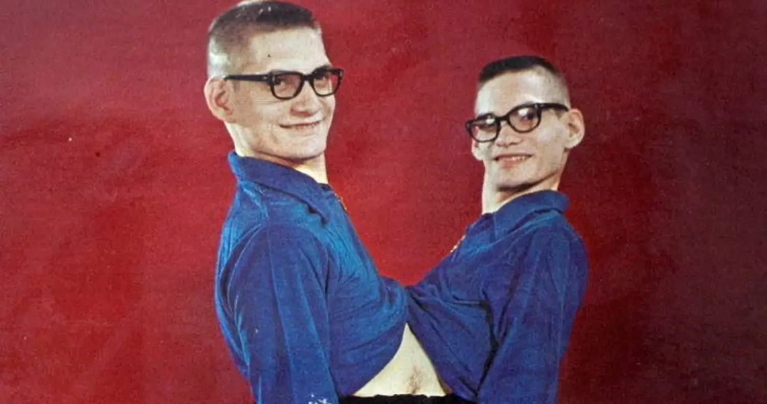 Ronnie And Donnie Galyon: The Longest-Living Conjoined Twins In History