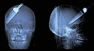 Knife In Head X-Ray