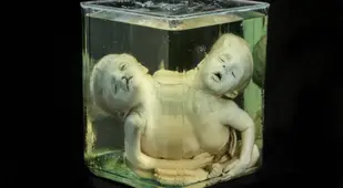 Conjoined Twin Specimen At Mutter Museum