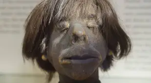 Human Head At The Mutter Museum