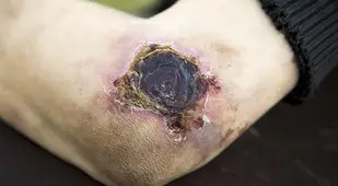 Krokodil Elbow Flesh