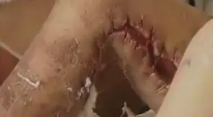 Krokodil Ripped Flesh