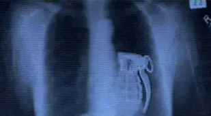 Live Grenade In Stomach
