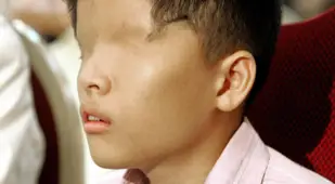 Agent Orange Victims Eyes