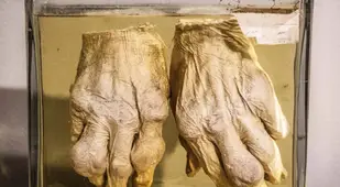 Mütter Museum Exhibits