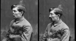 Early Cosmetic Surgery