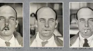 Patient Of Harold Gillies