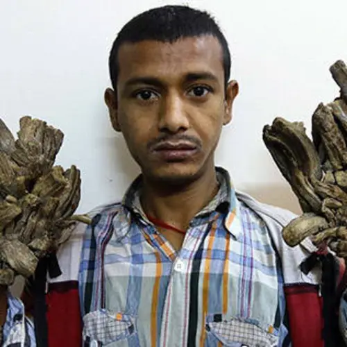"Tree Man" Syndrome Turns People Into Living, Breathing Pieces Of Bark