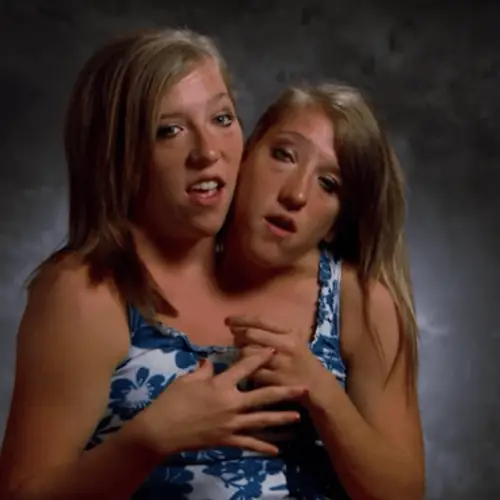 The Incredible Story Of Conjoined Twins Abby And Brittany Hensel