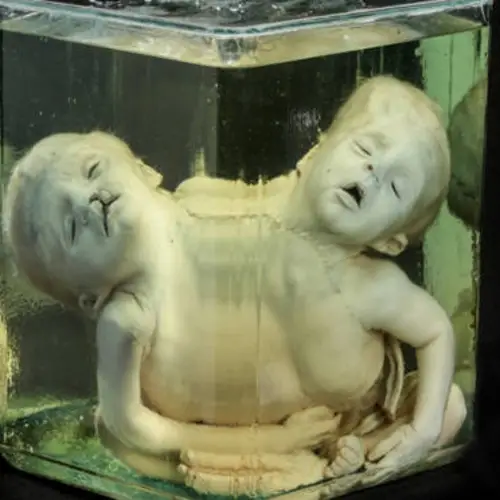 25 Medical Oddities On Display At The Mütter Museum