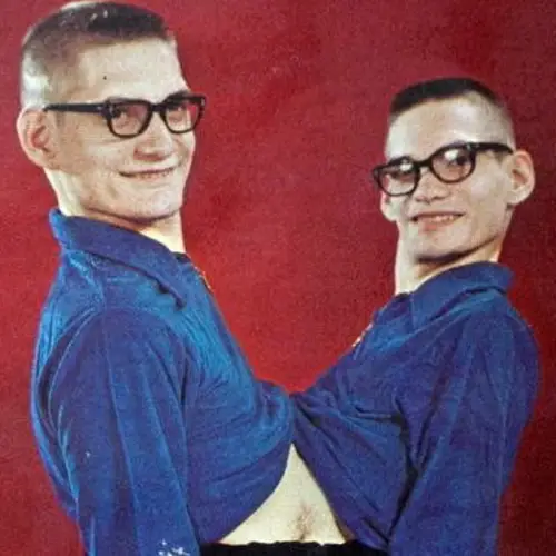 Ronnie And Donnie Galyon: The Longest-Living Conjoined Twins In History