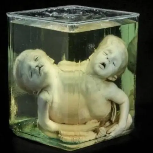 Inside The Mütter Museum Of Philadelphia, Where Some Of History's Strangest Medical Oddities Are On Display