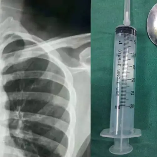Chinese Man Swallows Spoon On A Dare — And It Gets Stuck In His Esophagus For A Year