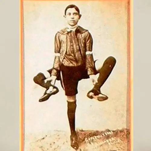 Meet Frank Lentini, The Sideshow Performer With Three Legs, 16 Fingers, And Two Penises