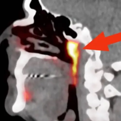 Cancer Researchers Accidentally Find Secret Organ Hidden Inside The Human Head
