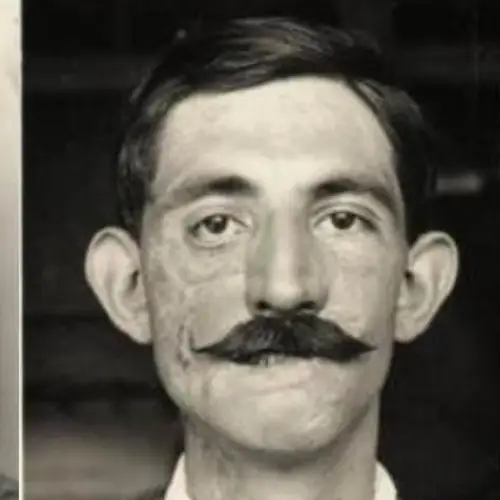 25 Before-And-After Pictures Of World War I Soldiers Who Were Helped By Pioneering Plastic Surgeon Harold Gillies