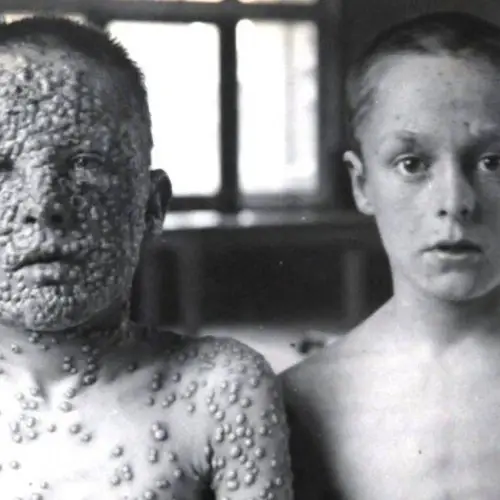 27 Photos That Illustrate The Devastating History Of Smallpox