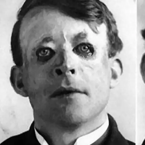 Walter Yeo And When Plastic Surgery Was Worse Than The Injury