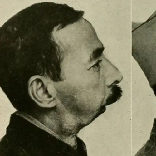 Before-And-After Photos Of Plastic Surgery's Early Days