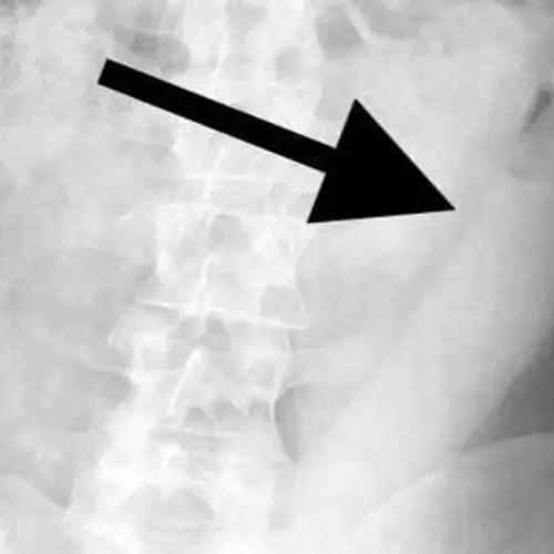 Doctors Were Forced To Invent A New Tool When This 23-Inch Dildo Got Stuck In A Man's Rectum
