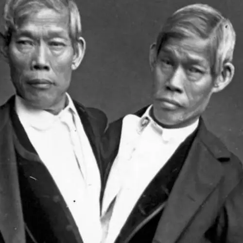 Everything You Ever Wanted To Know About Conjoined Twins