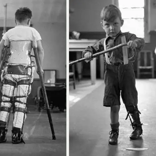 44 Grim Photos That Show The Brutal Reality Of Mid-Century America's Polio Epidemics
