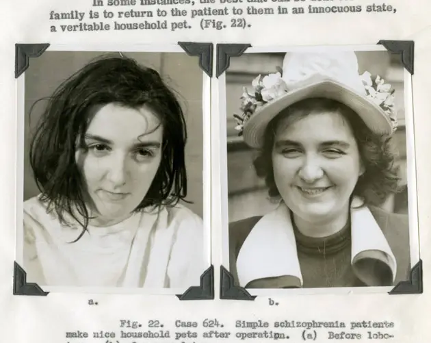 Schizophrenia Patient Before And After A Lobotomy