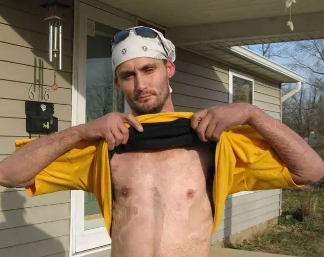 Meth Epidemic Burns