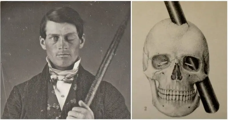 The Shocking Story Of Phineas Gage, The Railroad Worker Who Survived A Spike Through His Skull