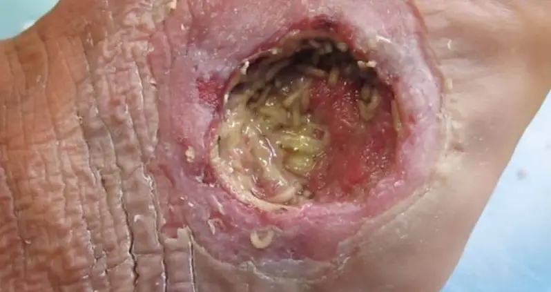 Maggot Therapy Is The Disgusting Medical Practice That Will Save Your Life