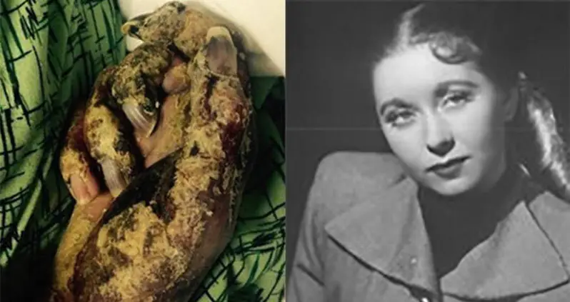 Woman “Eaten Alive” By Mites As Nursing Home Staff Let It Happen