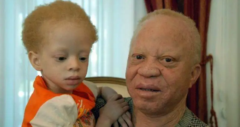 Five-Year-Old Albino Child Beheaded In Ritual Killing