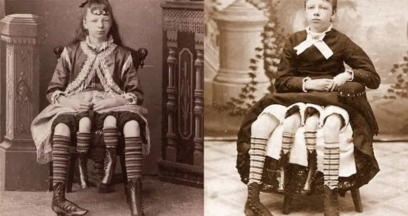 The Story Of Myrtle Corbin, P.T. Barnum’s “Four-Legged Girl From Texas”