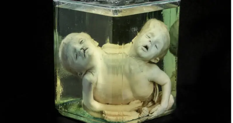 25 Medical Oddities On Display At The Mütter Museum