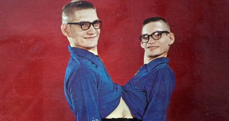 Ronnie And Donnie Galyon: The Longest-Living Conjoined Twins In History