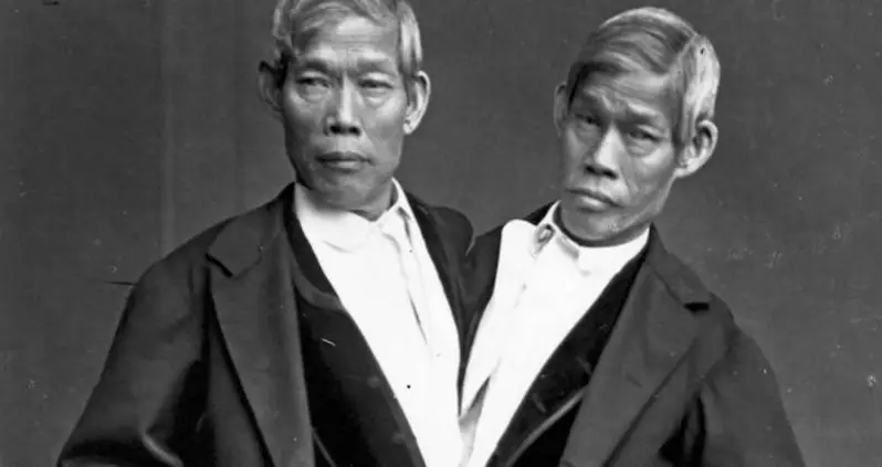 Everything You Ever Wanted To Know About Conjoined Twins