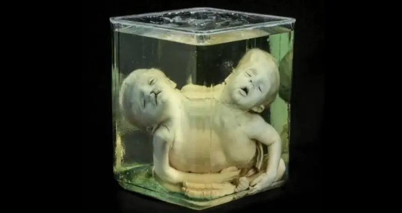 Inside The Mütter Museum Of Philadelphia, Where Some Of History’s Strangest Medical Oddities Are On Display