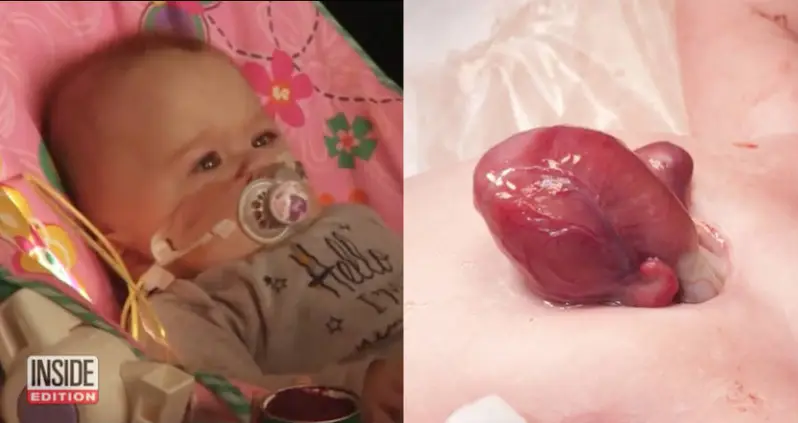 A Baby Born With Her Heart Outside Her Chest Will Go Home After 9 Months In The Hospital