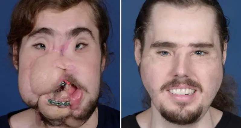 Record-Setting Face Transplant Gives California Man New Lease On Life