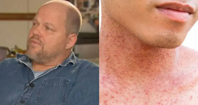 Vancouver Dad Who Caused Measles Outbreak Didn’t Vaccinate Kids Due To Autism Concerns