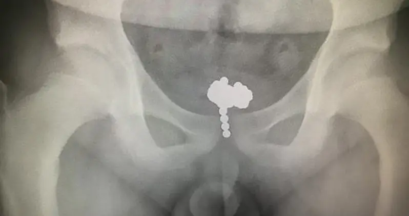 11-Year-Old Chinese Boy Has 70 Magnetic Balls Surgically Removed From His Penis