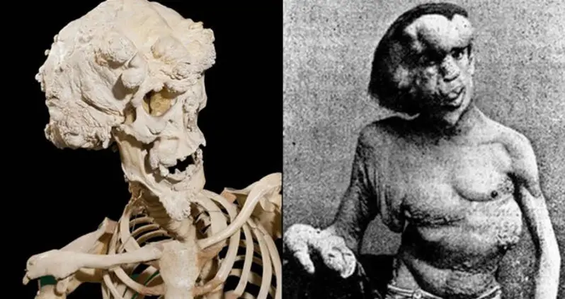 Remains Of Deformed “Elephant Man” Found In An Unmarked London Grave