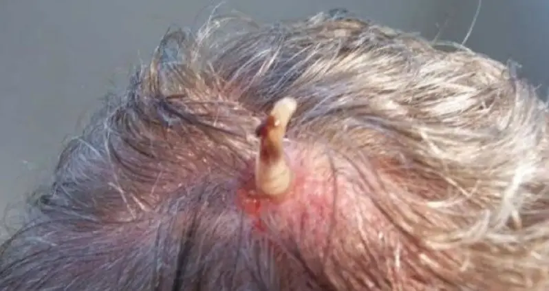 Real-Life ‘Alien’: Meet The Parasitic Botfly That Bursts Through Human Skin