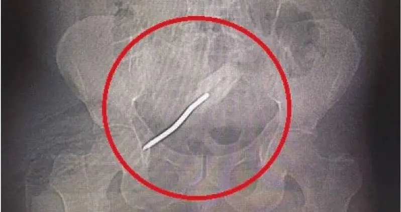 Florida Man Lodges Eight-Inch Screwdriver Inside His Rectum — And Loses Part Of His Buttocks In The Process