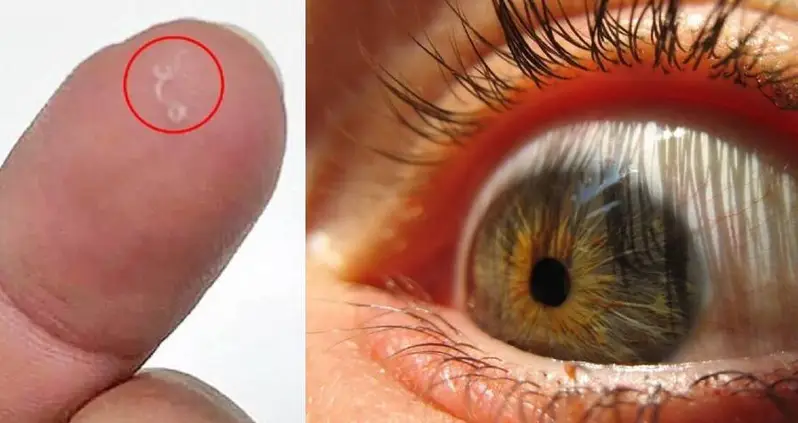 Woman Finds Four Parasitic Worms In Her Eye — And Pulls Out Three Of Them Herself