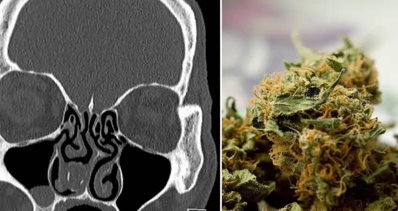 A Man Tried To Smuggle Pot Inside His Nose — But Then He Got It Stuck There For 18 Years