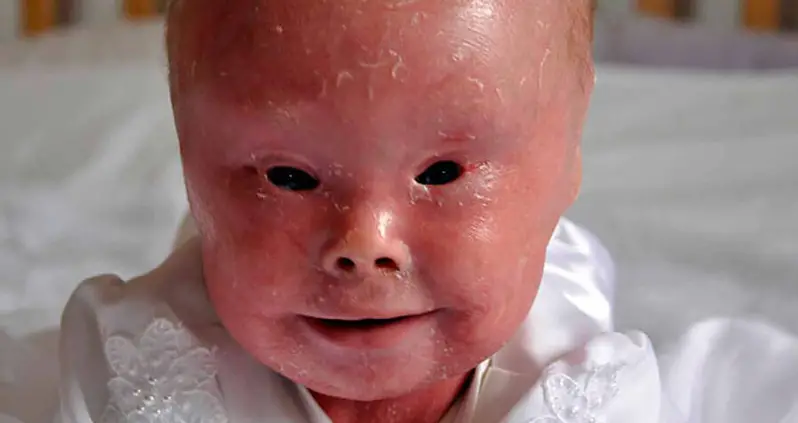 Harlequin Ichthyosis, The Rare Condition That Leaves Sufferers Mistaken For Dolls